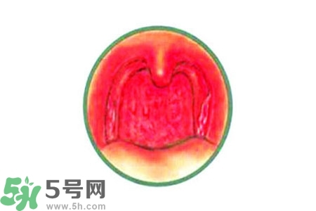 慢性咽炎的治療方法？慢性咽炎的藥物治療？