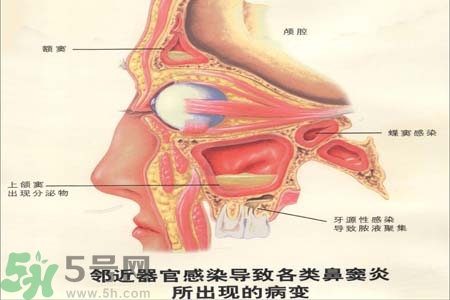 鼻竇炎是什么？鼻竇炎的癥狀有哪些？