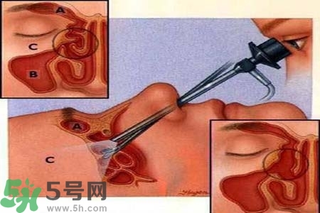 鼻竇炎的高發(fā)人群？如何預(yù)防鼻竇炎？