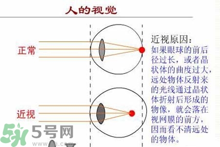 近視眼的發(fā)病因素？近視眼的并發(fā)癥有哪些？