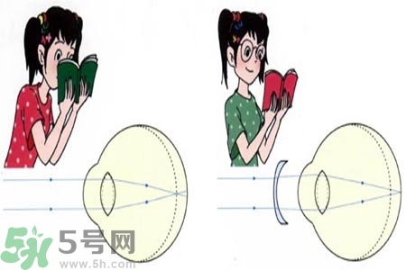 近視眼的發(fā)病因素？近視眼的并發(fā)癥有哪些？