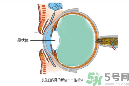 白內(nèi)障的護理措施是什么？白內(nèi)障的飲食護理有哪些？