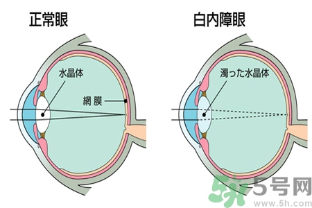 白內(nèi)障的發(fā)病因素是什么？白內(nèi)障并發(fā)癥有哪些？