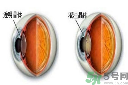 白內(nèi)障治療方法是什么？白內(nèi)障可以用什么藥物治療？