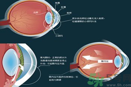 青光眼是什么？青光眼癥狀有什么？
