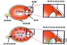 青光眼的發(fā)病因素是什么？青光眼的并發(fā)癥有哪些？
