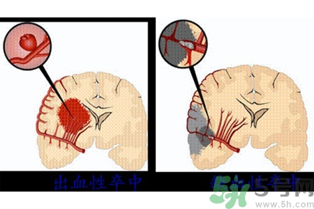 腦出血的發(fā)病因素是什么？腦出血的并發(fā)癥有哪些？