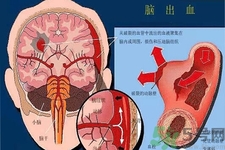 腦出血的發(fā)病因素是什么？腦出血的并發(fā)癥有哪些？