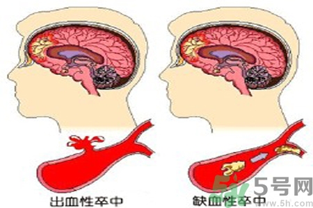 腦出血的治療方法是什么？腦出血可以用哪些藥物治療？