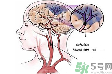 腦出血的治療方法是什么？腦出血可以用哪些藥物治療？