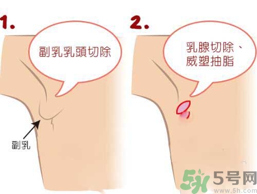 副乳是什么？副乳的危害