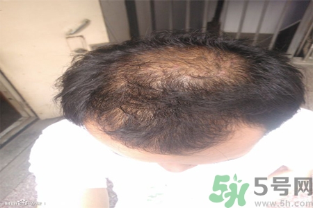脫發(fā)的措施有什么？脫發(fā)的注意飲食有哪些？