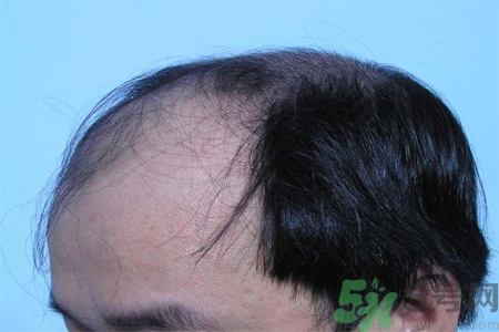 脫發(fā)的措施有什么？脫發(fā)的注意飲食有哪些？