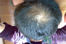 脫發(fā)的高發(fā)人群有哪些？如何預(yù)防脫發(fā)？