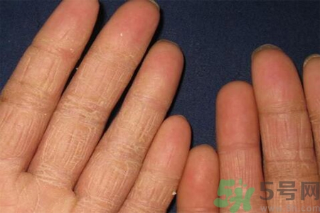 手足癬的治療方法？治療手足癬可以用什么藥？
