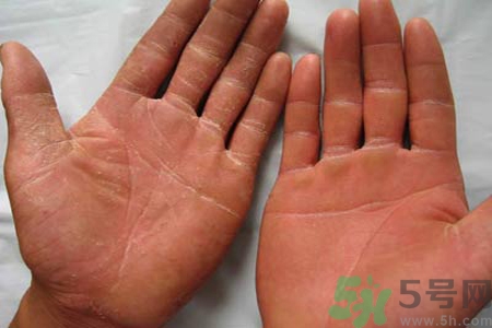 手足癬的治療方法？治療手足癬可以用什么藥？