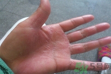 手足癬的易發(fā)人群有哪些？如何預(yù)防手足癬？