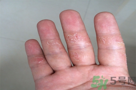 手足癬的易發(fā)人群有哪些？如何預(yù)防手足癬？