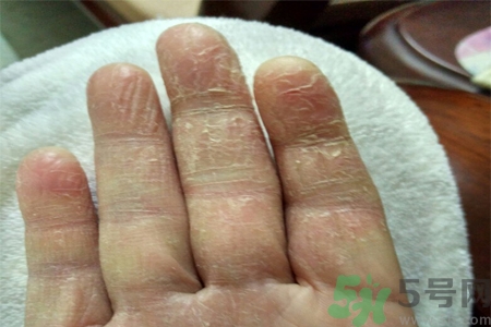 手足癬會傳染嗎？手足癬的傳播途徑有哪些？