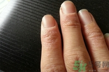 手足癬會傳染嗎？手足癬的傳播途徑有哪些？