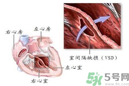 先天性心臟病是什么？先天性心臟病的癥狀有哪些？
