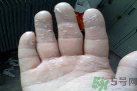 手足癬的易發(fā)人群有哪些？如何預(yù)防手足癬？