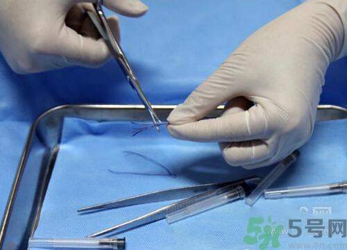 埋線減肥多少錢一次？埋線減肥的副作用