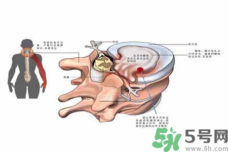 為什么年輕人容易得頸椎病？頸椎病嚴(yán)重的癥狀有哪些？