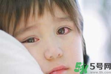 寶寶為什么會(huì)感染紅眼?。繉殞毣技t眼病如何治療？