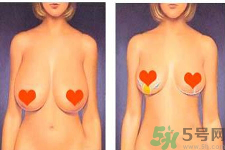 ?女性乳房下垂的原因是什么？女性乳房下垂的分類有哪些？