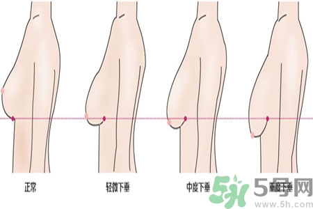 ?女性乳房下垂的原因是什么？女性乳房下垂的分類有哪些？