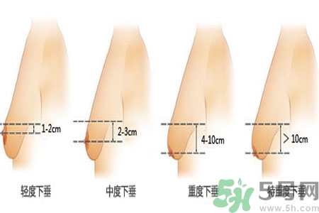 ?女性乳房下垂的原因是什么？女性乳房下垂的分類有哪些？