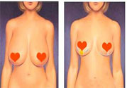 ?女性乳房下垂的原因是什么？女性乳房下垂的分類有哪些？