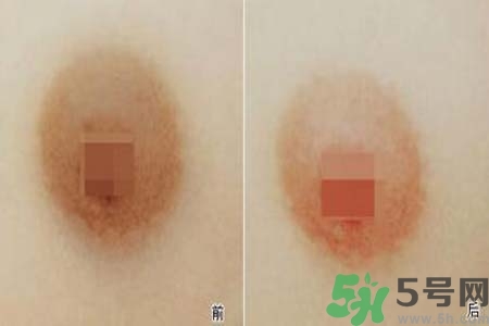 乳頭發(fā)黑怎么辦？怎么樣可以使乳頭變白？