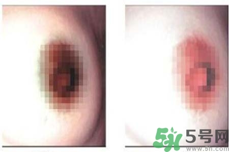 乳頭發(fā)黑怎么辦？怎么樣可以使乳頭變白？