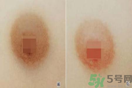 乳頭發(fā)黑是怎么回事？乳頭發(fā)黑是什么原因？