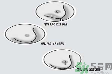 乳頭內陷怎么回事？乳頭內陷的原因是什么？