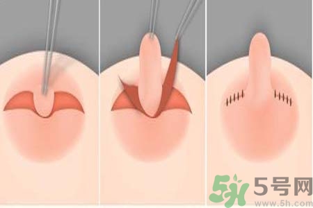 乳頭內陷怎么回事？乳頭內陷的原因是什么？