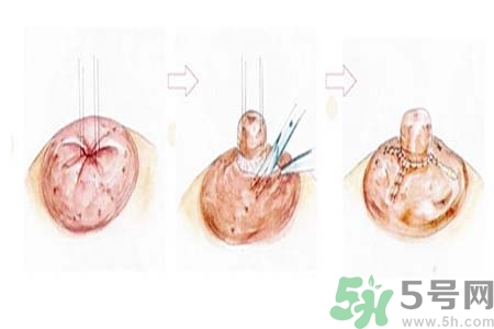 乳頭內陷怎么回事？乳頭內陷的原因是什么？