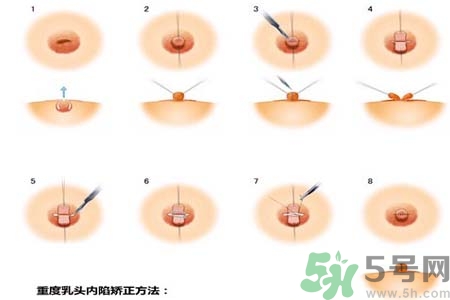 乳頭內陷怎么回事？乳頭內陷的原因是什么？