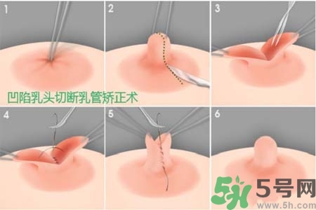 乳頭內(nèi)陷怎么辦？乳頭內(nèi)陷的癥狀有哪些？