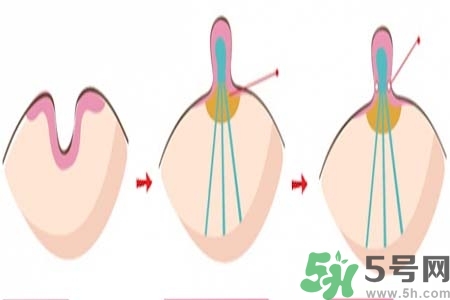 乳頭內(nèi)陷怎么辦？乳頭內(nèi)陷的癥狀有哪些？