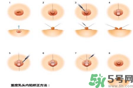 乳頭內(nèi)陷怎么辦？乳頭內(nèi)陷的癥狀有哪些？