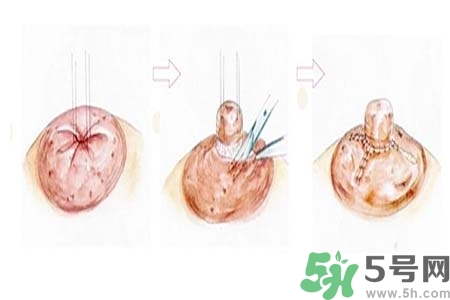 乳頭內(nèi)陷怎么辦？乳頭內(nèi)陷的癥狀有哪些？