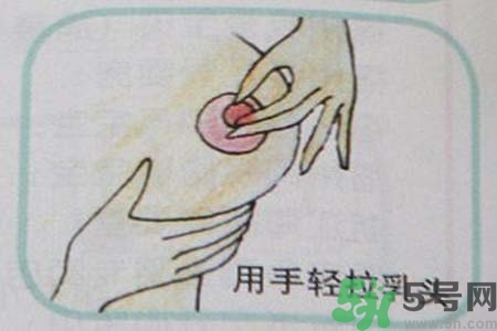 乳頭內(nèi)陷怎么辦？乳頭內(nèi)陷的癥狀有哪些？