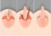 乳頭內(nèi)陷怎么辦？乳頭內(nèi)陷的癥狀有哪些？