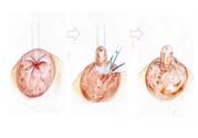 乳頭內(nèi)陷矯正需注意什么？乳頭內(nèi)陷如何預(yù)防？