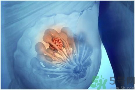 乳房有硬塊正常嗎？乳房有腫塊怎么回事？