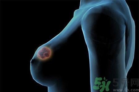 乳房有硬塊正常嗎？乳房有腫塊怎么回事？