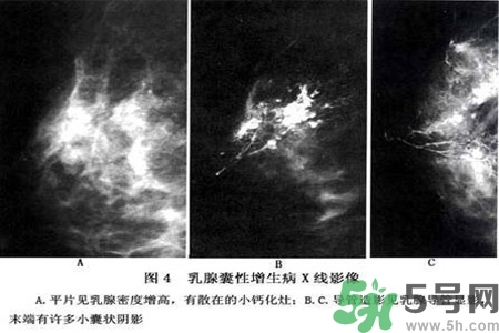 產(chǎn)生乳腺增生鈣化的病因是什么？乳腺增生怎樣治療？
